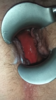 anus dilate speculum